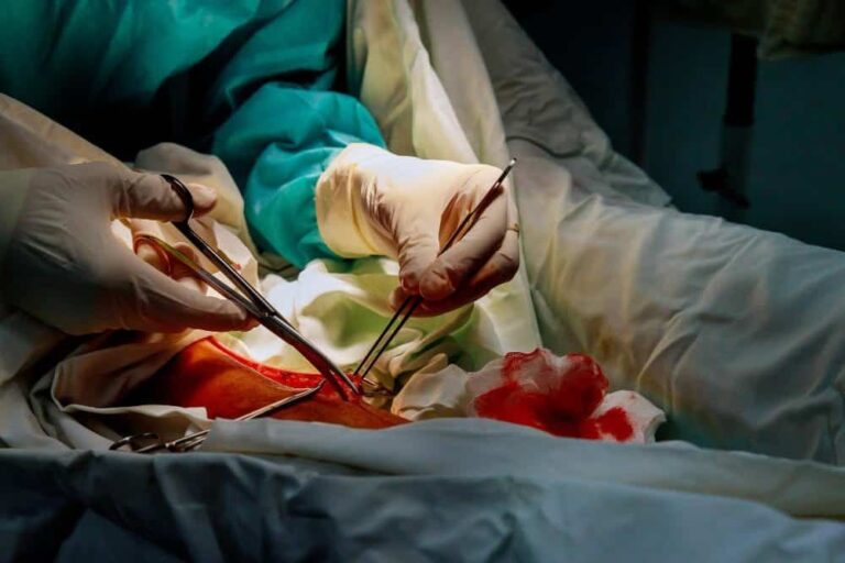 هل عملية استئصال الورم الليفي خطيرة