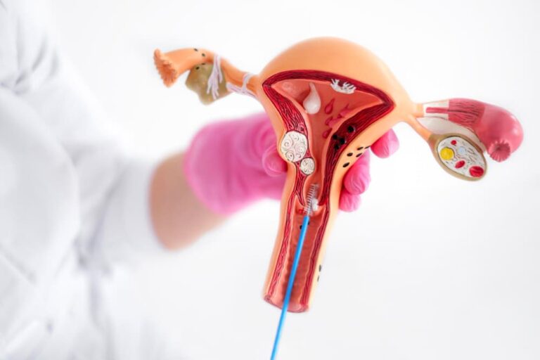 قسطرة الرحم للأورام الليفية