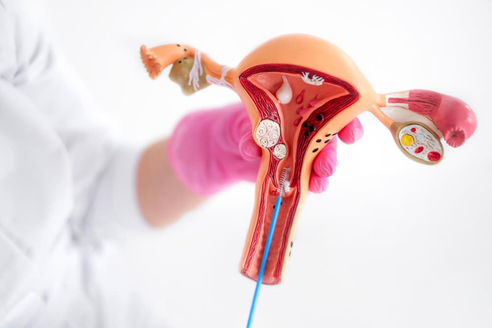 قسطرة الرحم للأورام الليفية