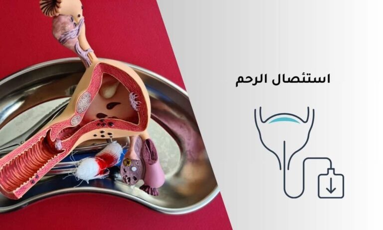 استئصال الرحم