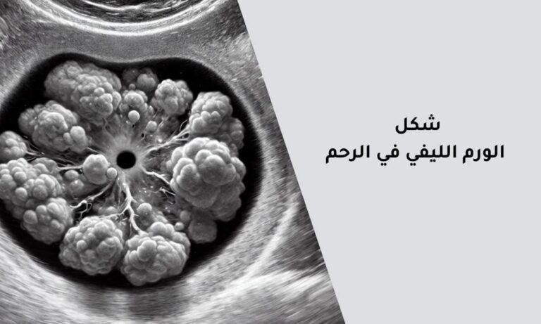 شكل الورم الليفي في الرحم