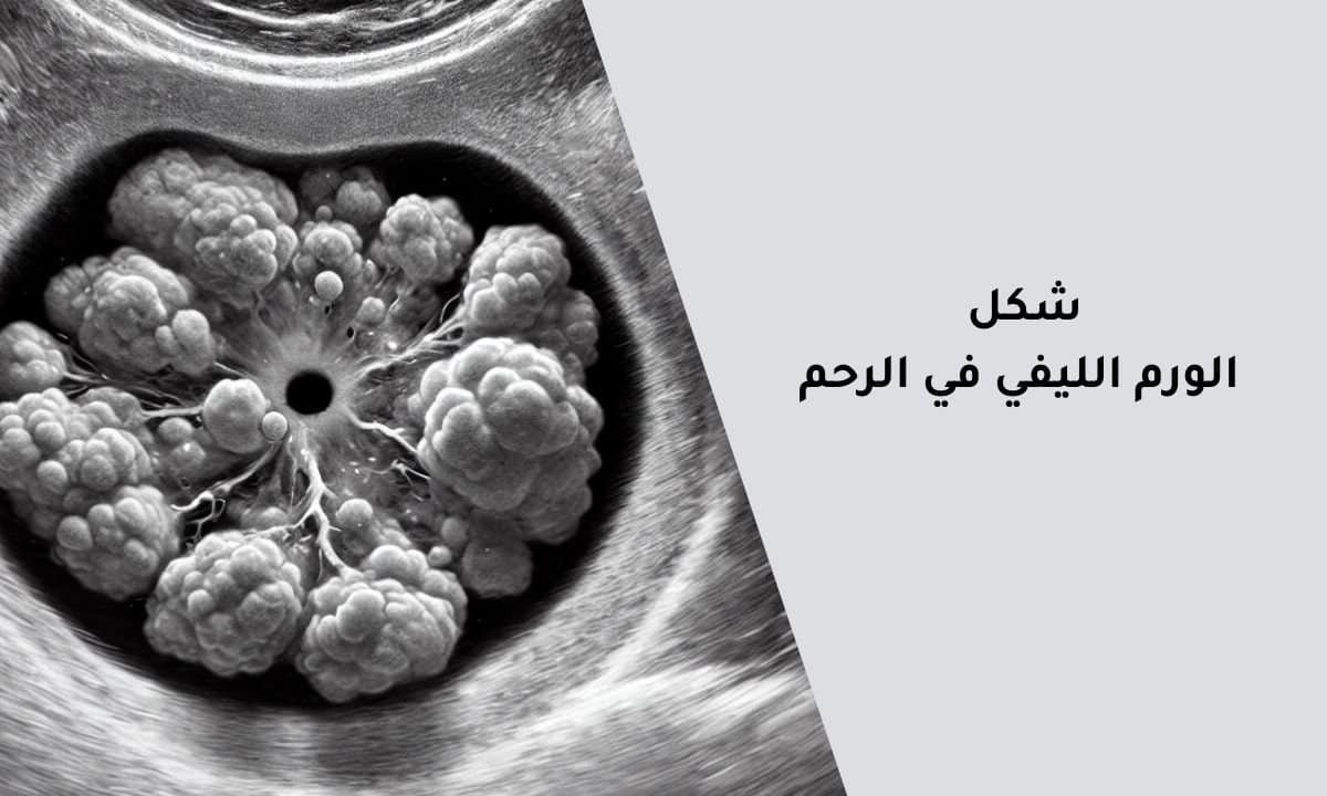 شكل الورم الليفي في الرحم